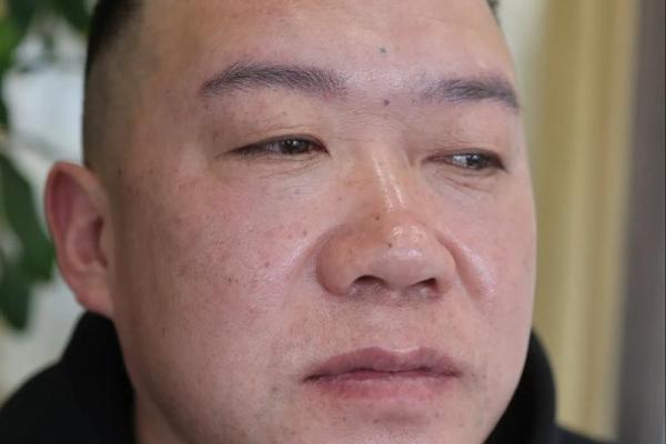 眉毛突然断眉要警惕四种病 眉毛突然出现断眉是怎么回事