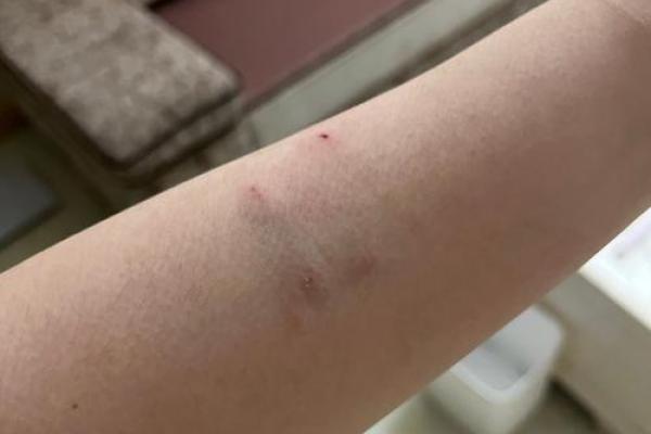 被猫咬了是不是不吉利 被猫咬了第二天肿了怎么办