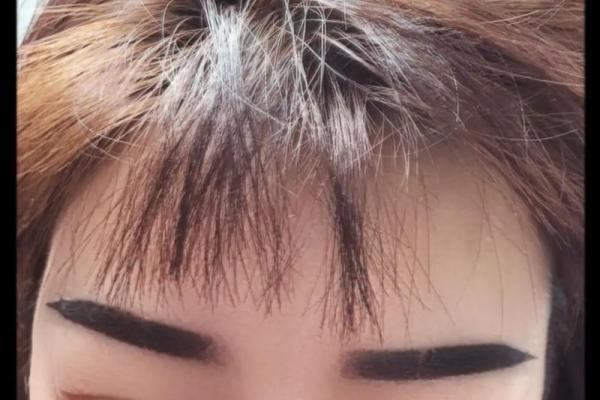 后天摔的眉毛算断眉吗 摔跤把眉毛摔掉了还会长吗