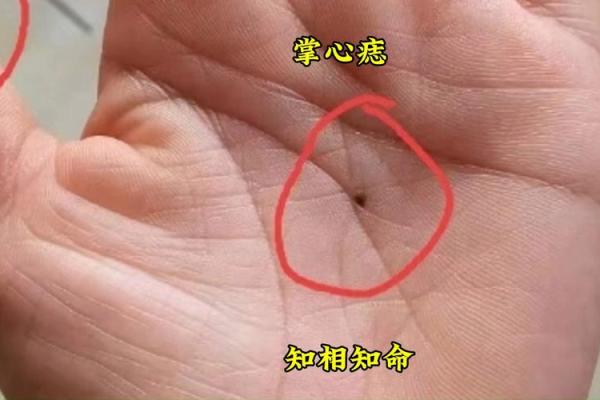 手掌痣的位置与命运(手掌痣的位置与命运图)