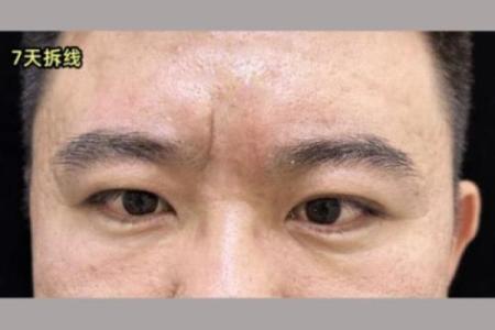 眉中横纹有什么说法 眉中间有横纹是心脏不好吗