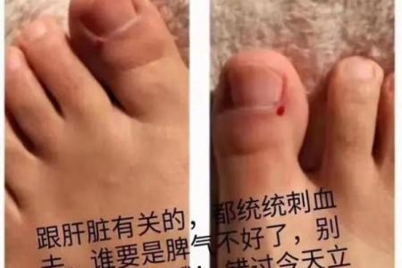 立春大敦放血禁忌 大敦放血的功效和作用